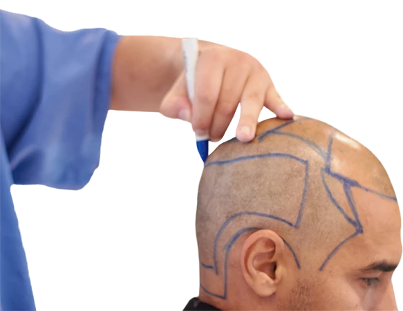 Exemplo do curso de implante capilar